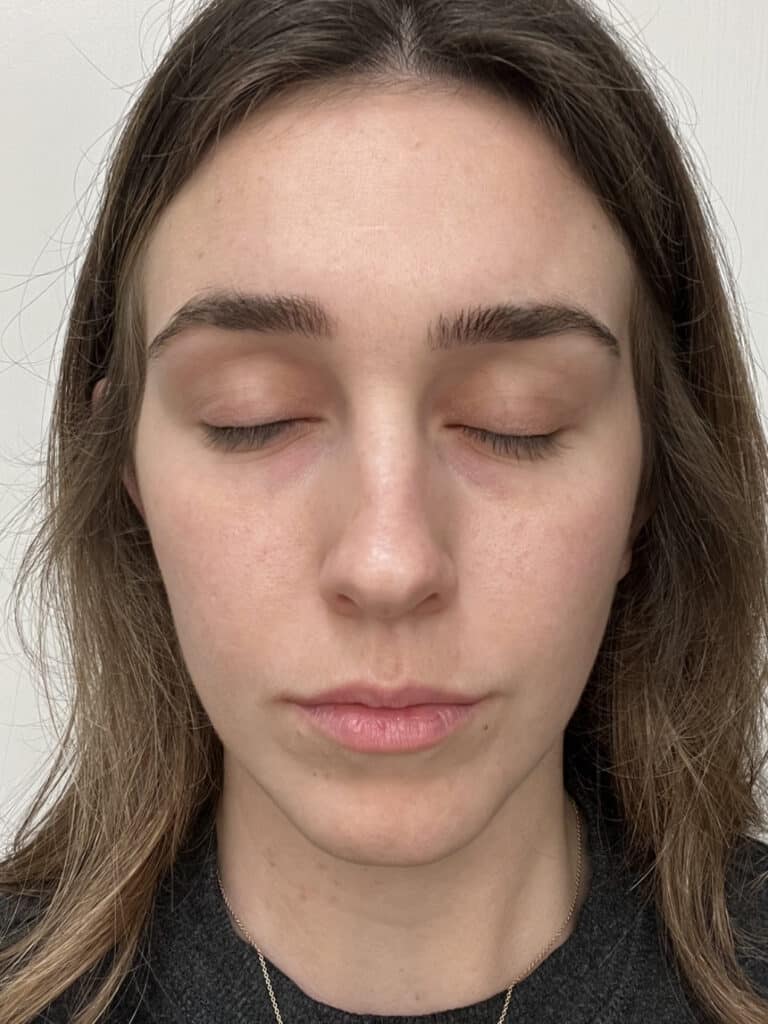 After Image: Vivace RF Microneedling - front