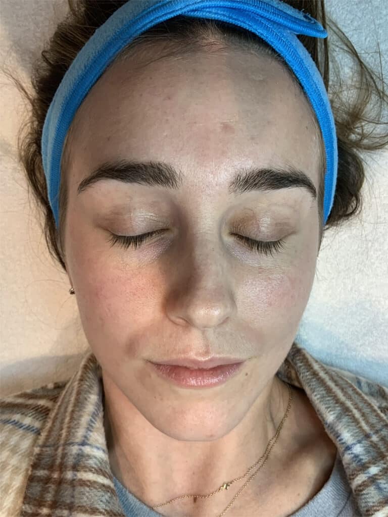 Before Image: Vivace RF Microneedling - front
