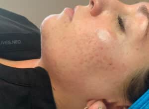 After Image: VI Peel