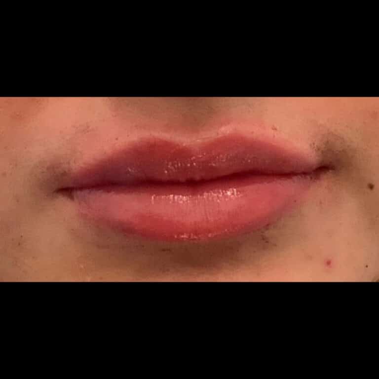 After Image: Lip Filler - front
