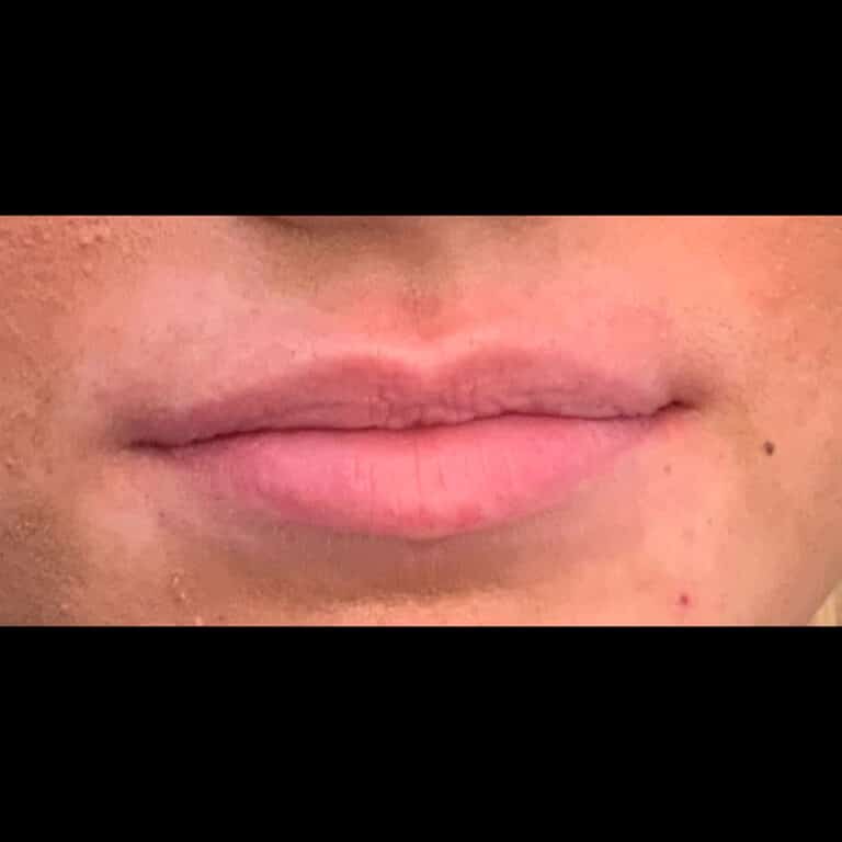 Before Image: Lip Filler - front